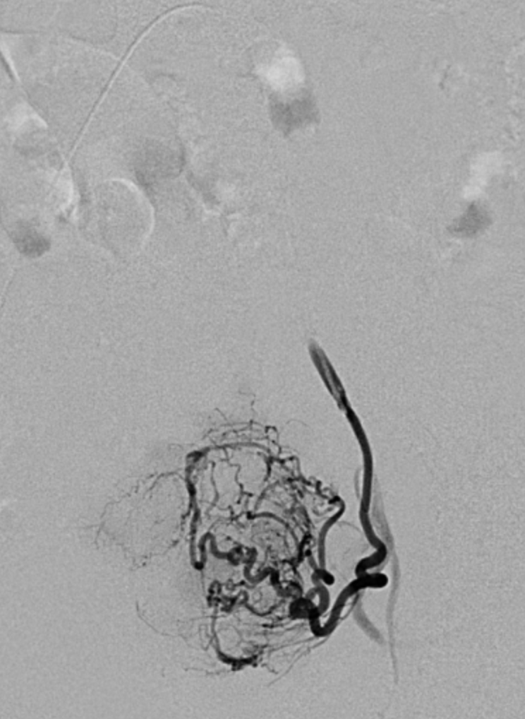 embolisation uterine nice