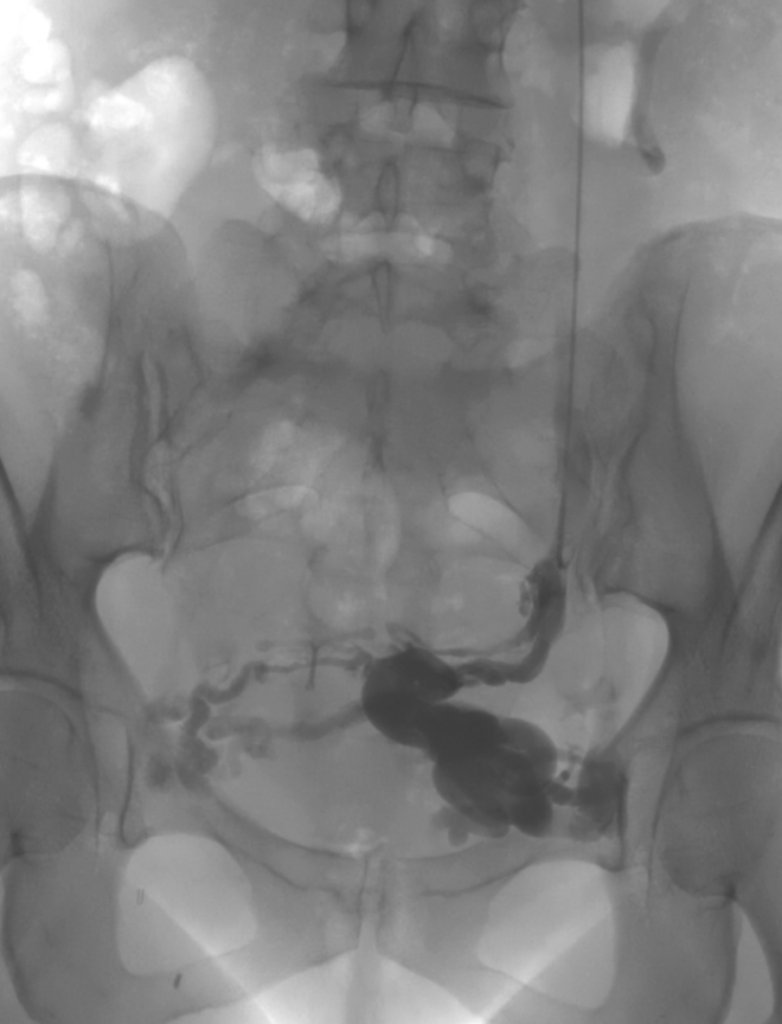 varices pelviennes nice