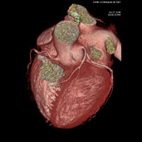 scanner cardiaque coroscanner