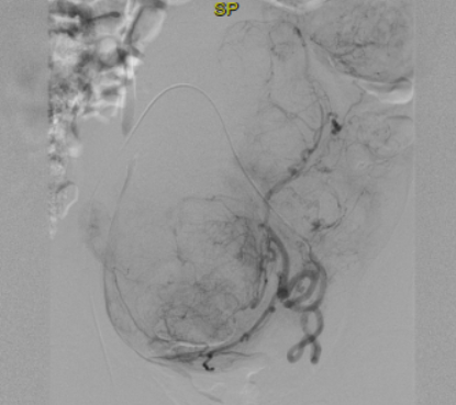 fibrome embolisation jean baque