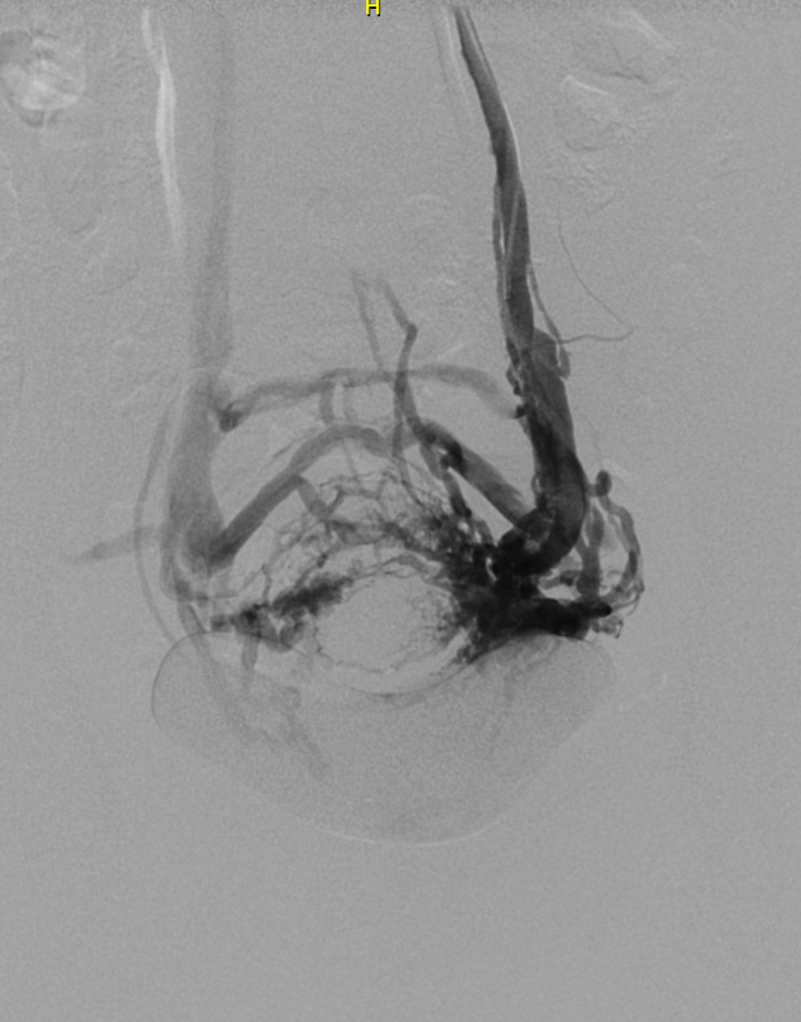 jean baqué varices pelviennes nice