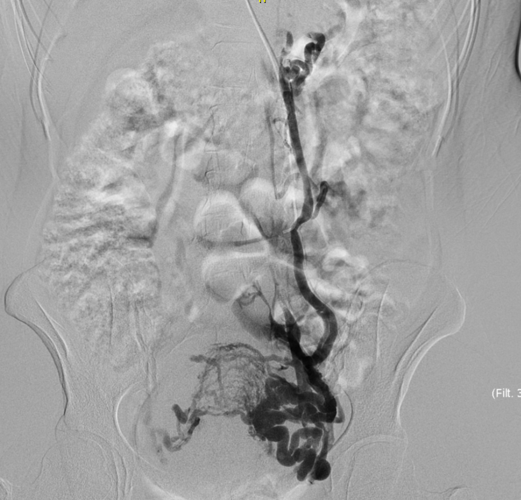 jean baqué varices pelviennes nice